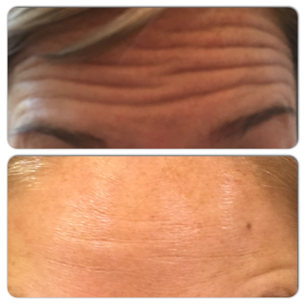 Botox Before & After Duluth, MN