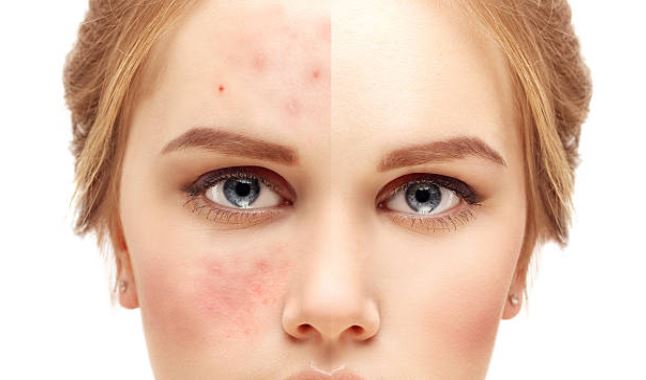 Duluth Rosacea