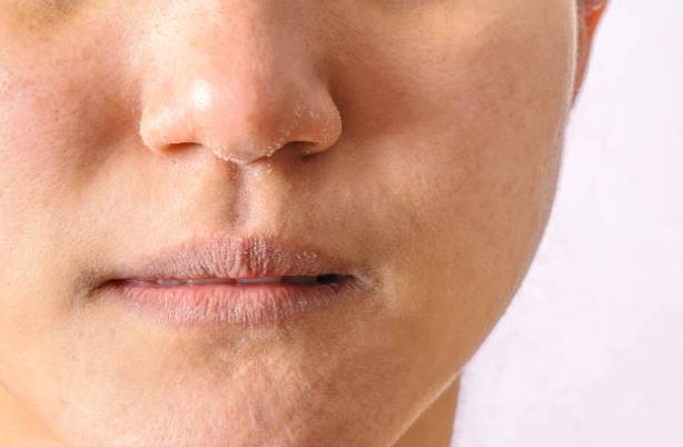 Winter rashes