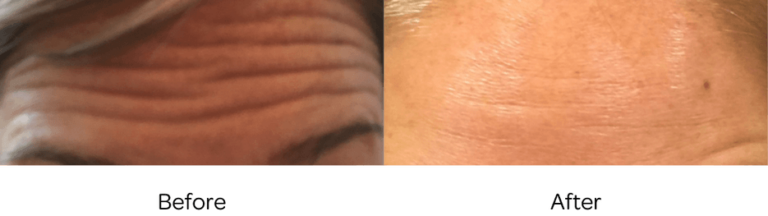 Twin Ports_Filler_Botox BA4